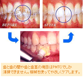 歯と歯の間や歯と歯茎の境目はPMTCでしか清掃できません。機械を使ってやさしくケアします。