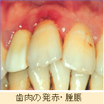 症例写真：歯肉の発赤・腫張