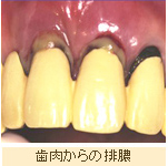 症例写真：歯肉からの排膿