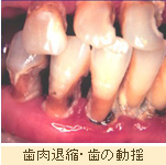 症例写真：歯肉退縮・歯の動揺